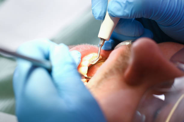 Best Knocked-Out Tooth (Avulsed Tooth) Treatment in Holtville, AL